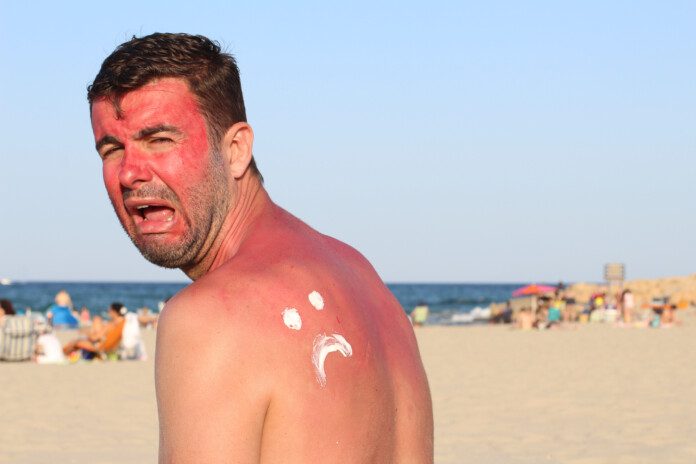 Man crying because he has a bad sunburn.
